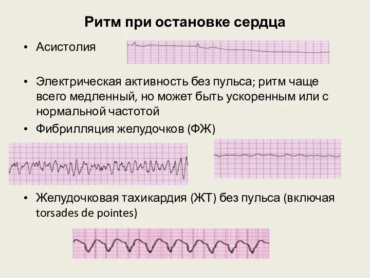 Ритм при остановке сердца Асистолия Электрическая активность без пульса; ритм чаще всего