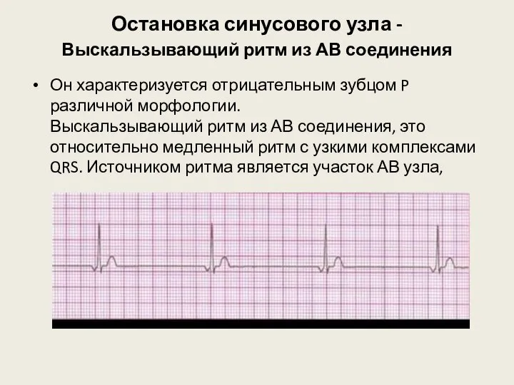 Остановка синусового узла - Выскальзывающий ритм из АВ соединения Он характеризуется отрицательным