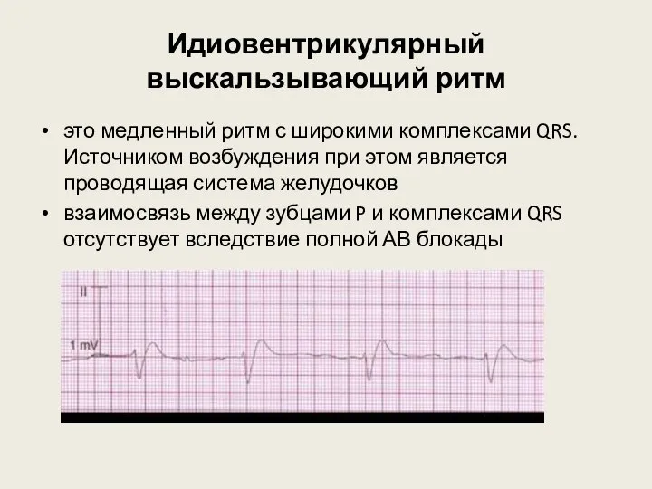Идиовентрикулярный выскальзывающий ритм это медленный ритм с широкими комплексами QRS. Источником возбуждения