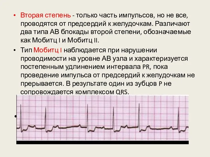 Вторая степень - только часть импульсов, но не все, проводятся от предсердий