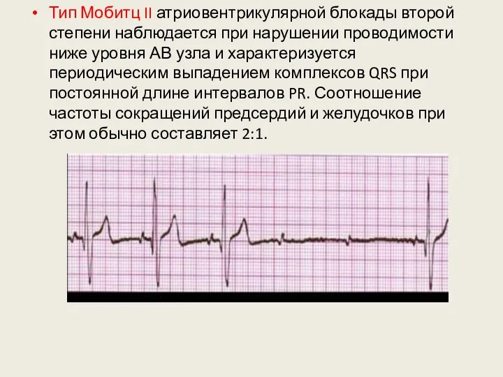 Тип Мобитц II атриовентрикулярной блокады второй степени наблюдается при нарушении проводимости ниже