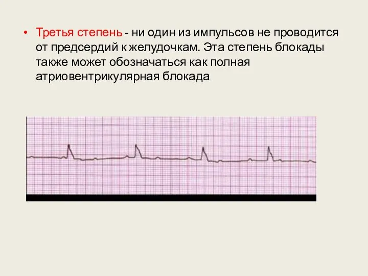 Третья степень - ни один из импульсов не проводится от предсердий к