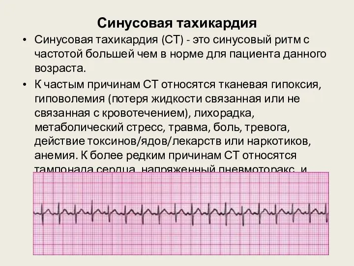Синусовая тахикардия Синусовая тахикардия (СТ) - это синусовый ритм с частотой большей