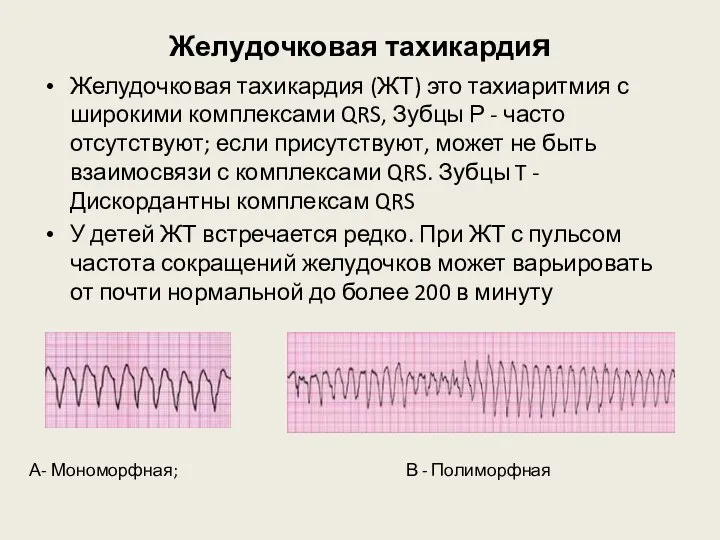 Желудочковая тахикардия Желудочковая тахикардия (ЖТ) это тахиаритмия с широкими комплексами QRS, Зубцы