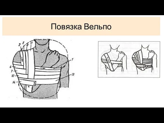 Повязка Вельпо