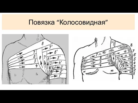 Повязка “Колосовидная”