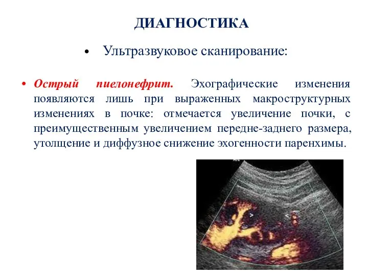 ДИАГНОСТИКА Ультразвуковое сканирование: Острый пиелонефрит. Эхографические изменения появляются лишь при выраженных макроструктурных