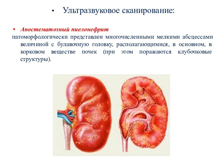 Ультразвуковое сканирование: Апостематозный пиелонефрит патоморфологически представлен многочисленными мелкими абсцессами величиной с булавочную