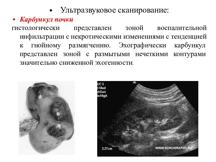 Ультразвуковое сканирование: Карбункул почки гистологически представлен зоной воспалительной инфильтрации с некротическими изменениями