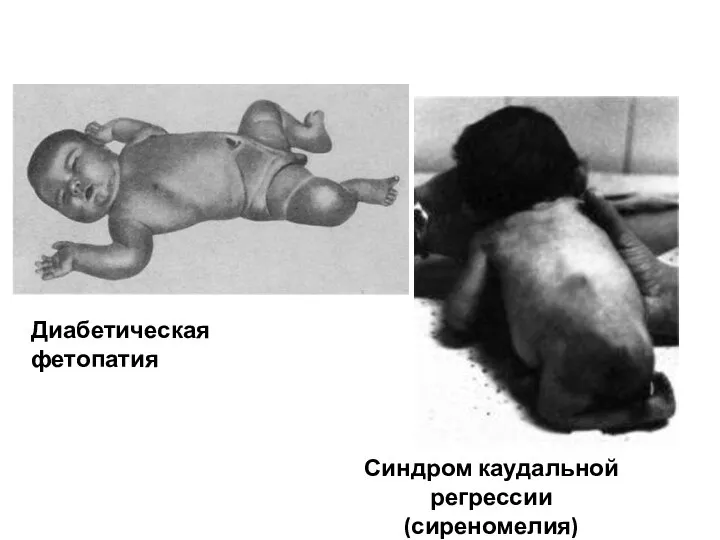 Диабетическая фетопатия Синдром каудальной регрессии (сиреномелия)