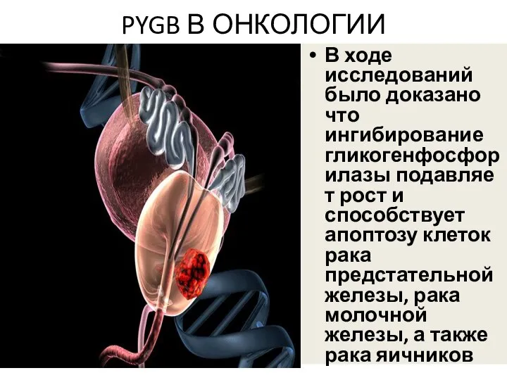 PYGB В ОНКОЛОГИИ В ходе исследований было доказано что ингибирование гликогенфосфорилазы подавляет