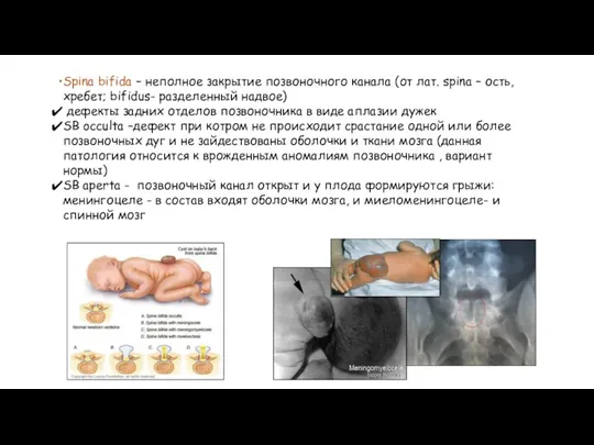 Spina bifida – неполное закрытие позвоночного канала (от лат. spina – ость,