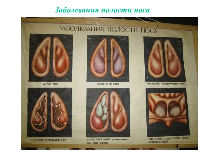 Заболевания полости носа