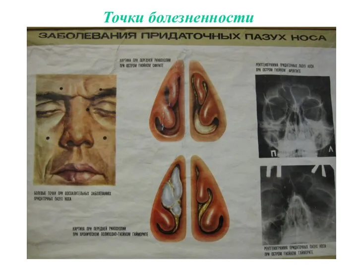 Точки болезненности