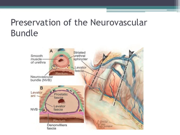 Preservation of the Neurovascular Bundle