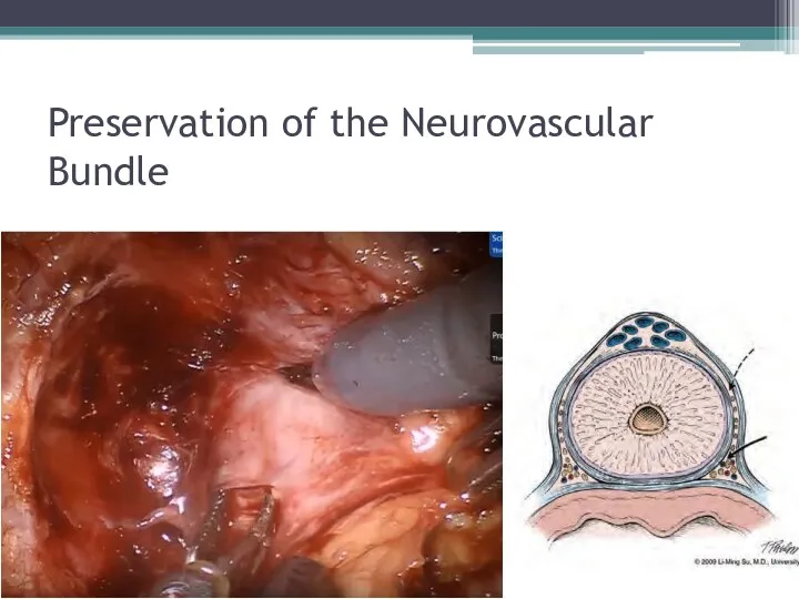 Preservation of the Neurovascular Bundle