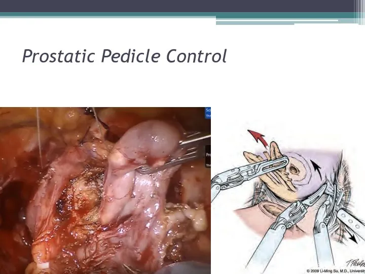 Prostatic Pedicle Control