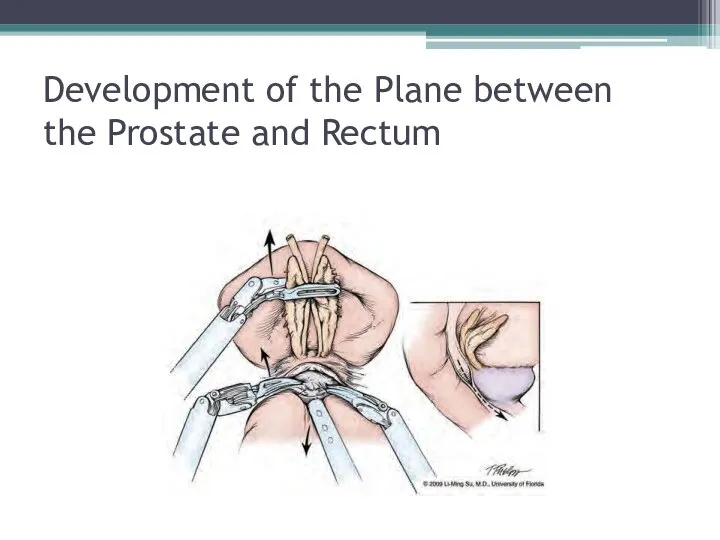 Development of the Plane between the Prostate and Rectum