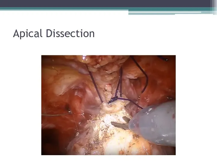 Apical Dissection