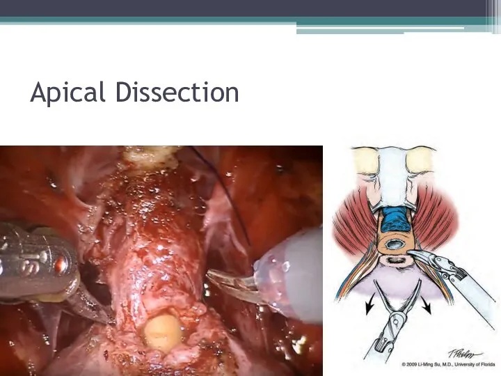 Apical Dissection