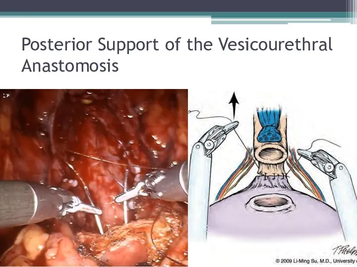 Posterior Support of the Vesicourethral Anastomosis