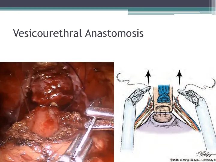 Vesicourethral Anastomosis