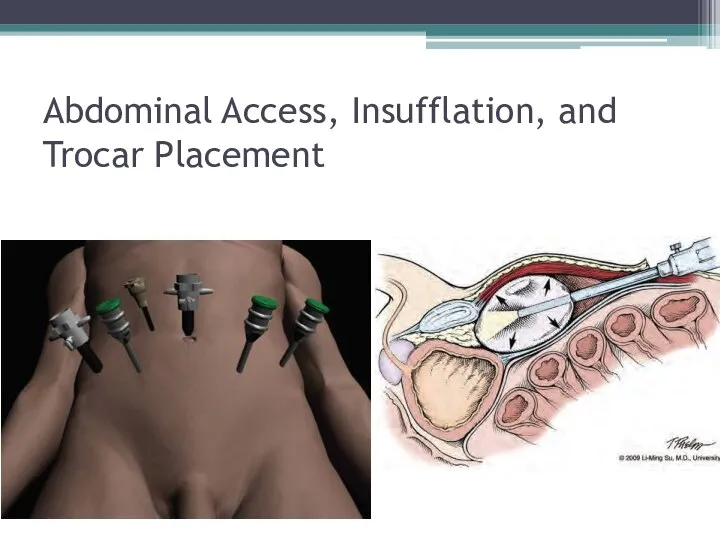 Abdominal Access, Insufflation, and Trocar Placement