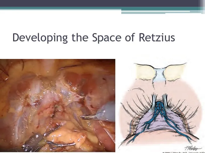 Developing the Space of Retzius