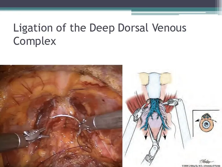 Ligation of the Deep Dorsal Venous Complex