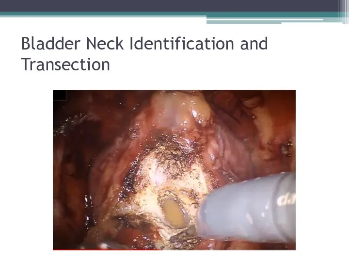 Bladder Neck Identification and Transection