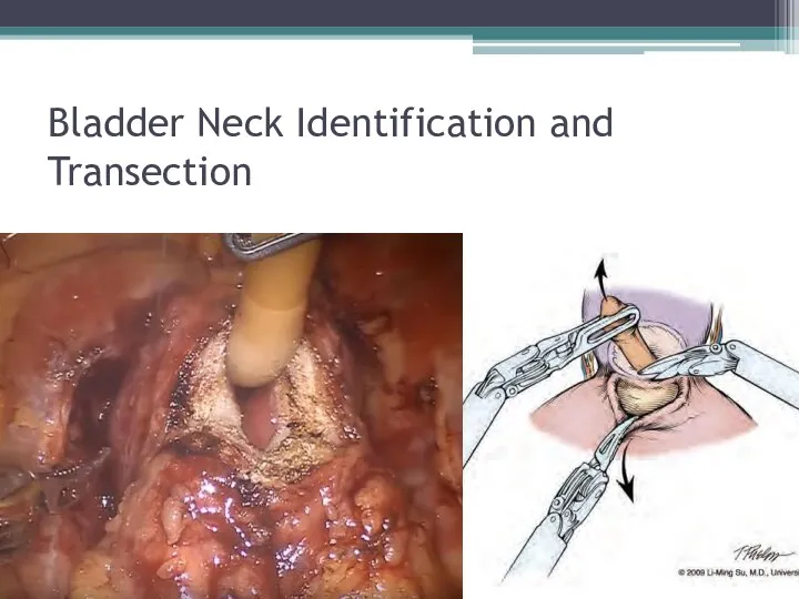 Bladder Neck Identification and Transection