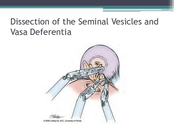 Dissection of the Seminal Vesicles and Vasa Deferentia