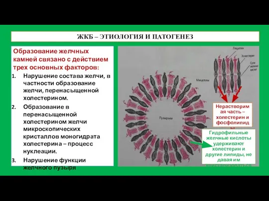 ЖКБ – ЭТИОЛОГИЯ И ПАТОГЕНЕЗ Образование желчных камней связано с действием трех