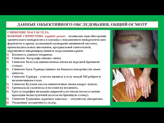 ДАННЫЕ ОБЪЕКТИВНОГО ОБСЛЕДОВАНИЯ, ОБЩИЙ ОСМОТР СНИЖЕНИЕ МАССЫ ТЕЛА. КОЖНЫЕ СИМПТОМЫ (крайне редко)