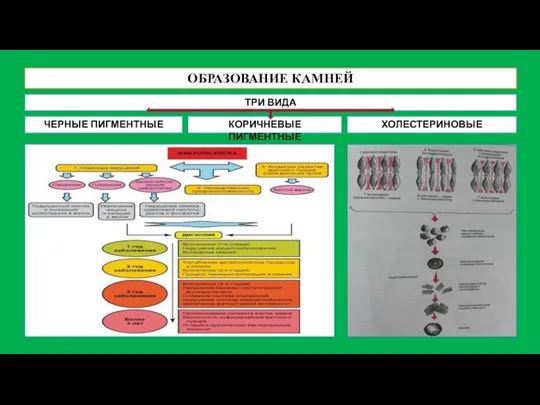 ОБРАЗОВАНИЕ КАМНЕЙ ЧЕРНЫЕ ПИГМЕНТНЫЕ ТРИ ВИДА КОРИЧНЕВЫЕ ПИГМЕНТНЫЕ ХОЛЕСТЕРИНОВЫЕ