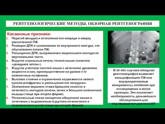 РЕНТГЕНОЛОГИЧЕСКИЕ МЕТОДЫ, ОБЗОРНАЯ РЕНТГЕНОГРАФИЯ Косвенные признаки: Перегиб желудка и оттеснение его кпереди