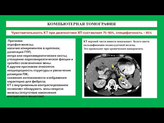 КОМПЬЮТЕРНАЯ ТОМОГРАФИЯ Чувствительность КТ при диагностике ХП составляет 75–90%, специфичность – 85%