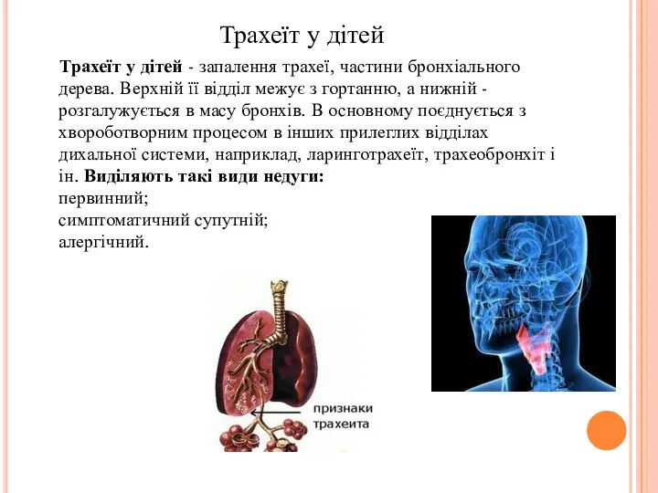 Трахеїт у дітей Трахеїт у дітей - запалення трахеї, частини бронхіального дерева.