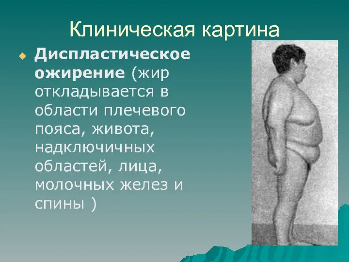 Клиническая картина Диспластическое ожирение (жир откладывается в области плечевого пояса, живота, надключичных