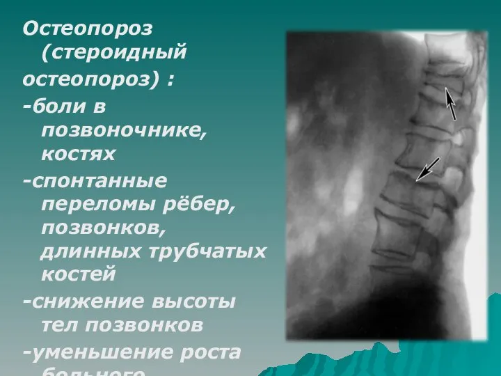 Остеопороз (стероидный остеопороз) : -боли в позвоночнике, костях -спонтанные переломы рёбер, позвонков,