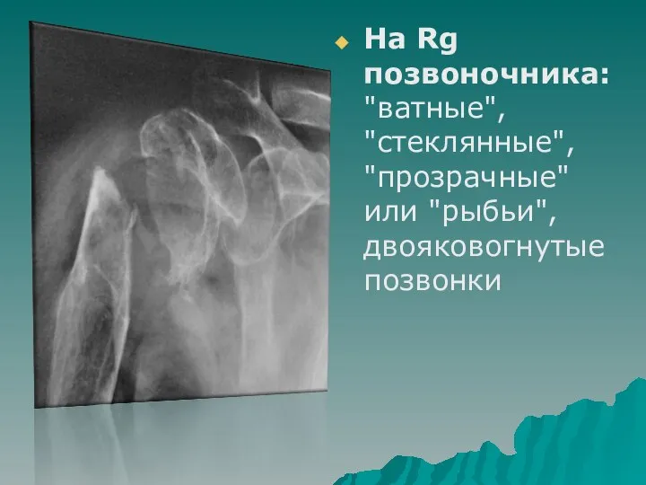 На Rg позвоночника: "ватные", "стеклянные", "прозрачные" или "рыбьи", двояковогнутые позвонки