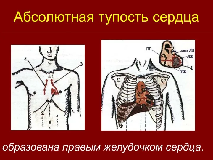 Абсолютная тупость сердца образована правым желудочком сердца.