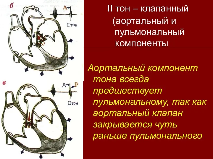 II тон – клапанный (аортальный и пульмональный компоненты Аортальный компонент тона всегда