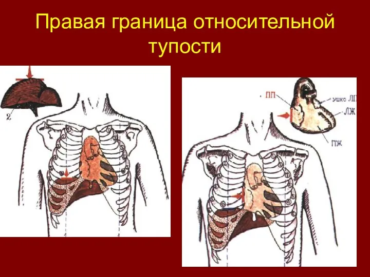 Правая граница относительной тупости