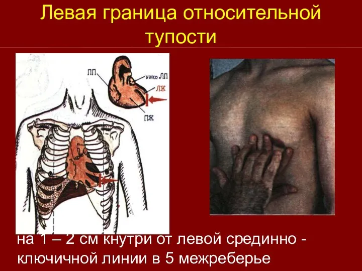 Левая граница относительной тупости на 1 – 2 см кнутри от левой