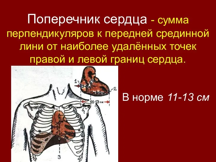 Поперечник сердца - сумма перпендикуляров к передней срединной лини от наиболее удалённых