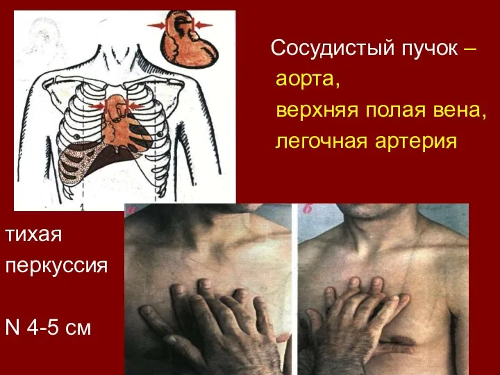 Сосудистый пучок – аорта, верхняя полая вена, легочная артерия тихая перкуссия N 4-5 см