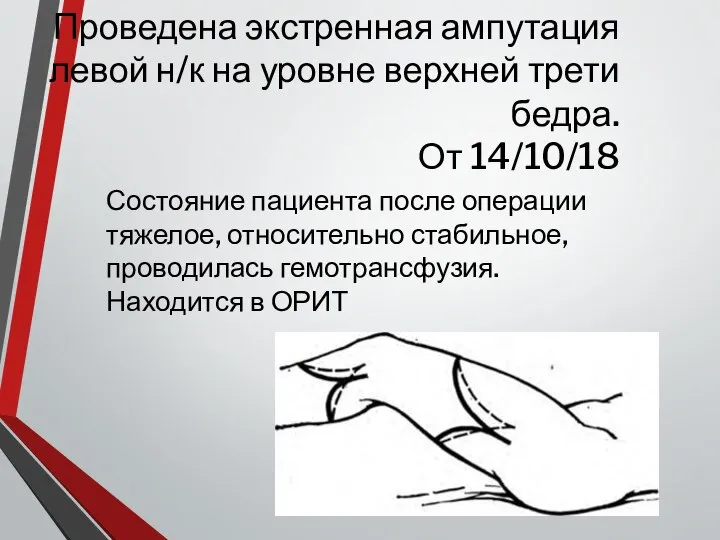 Проведена экстренная ампутация левой н/к на уровне верхней трети бедра. От 14/10/18