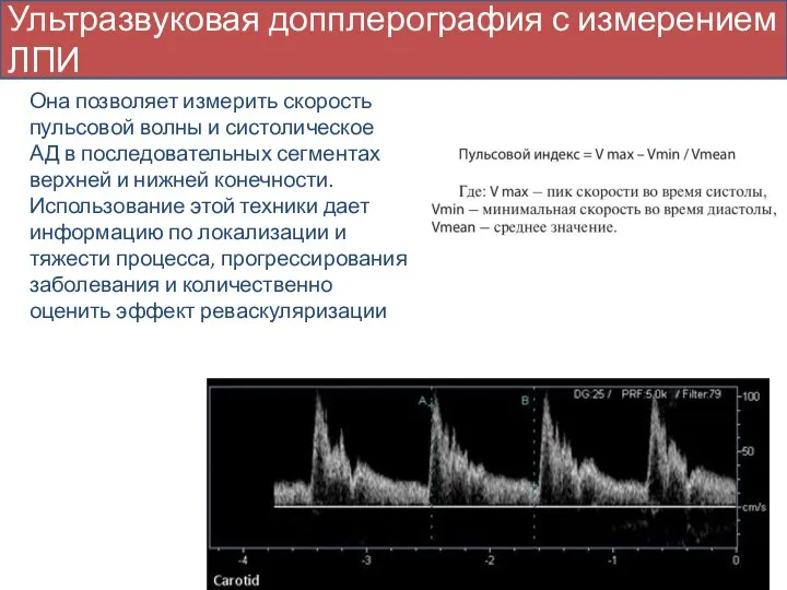 Ультразвуковая допплерография с измерением ЛПИ Она позволяет измерить скорость пульсовой волны и
