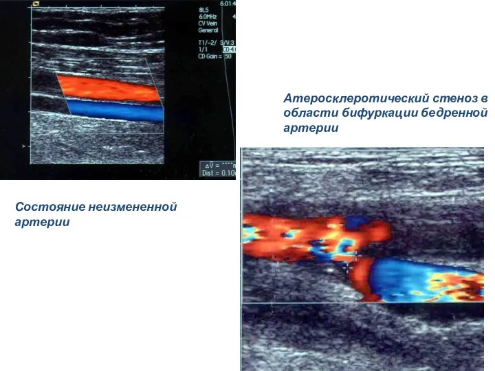 Состояние неизмененной артерии Атеросклеротический стеноз в области бифуркации бедренной артерии